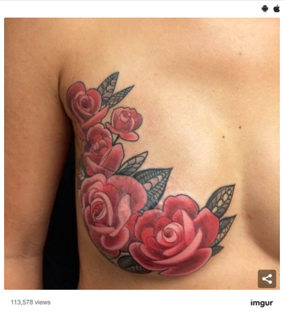 Publication publique Instagram d’un tatouage sur une cicatrice de mammographie